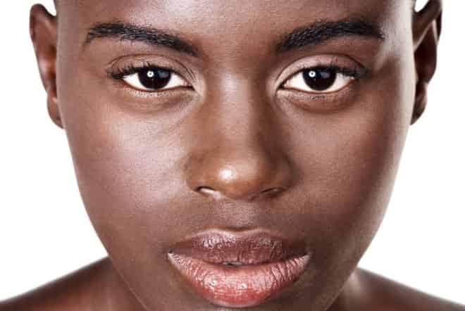 Dark Skins You CAN have laser treatments if you have dark skin
