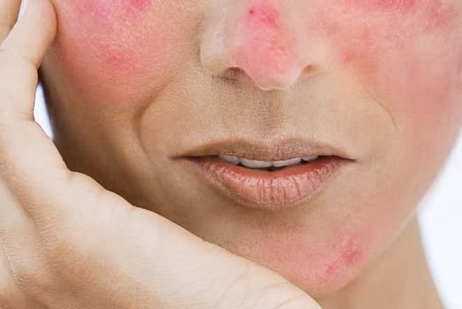 Struggling-with-rosacea-Its-time-to-change-your-diet