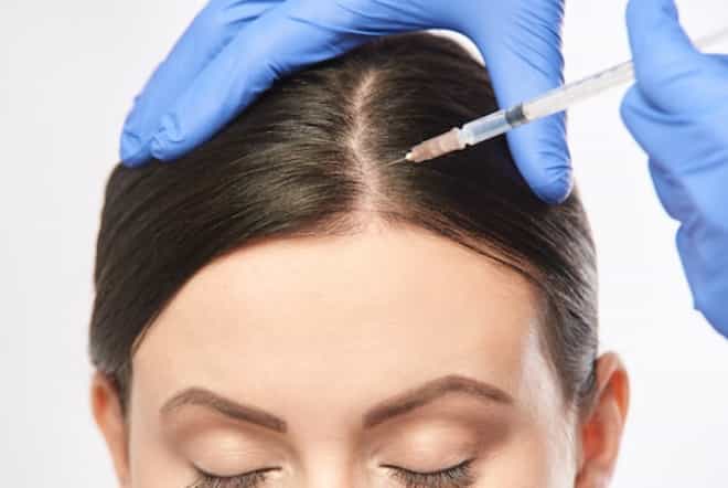 PRP for hair loss: Could this be the solution for you?