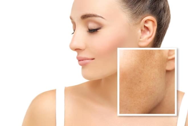 Melasma versus hyperpigmentation and how to treat it