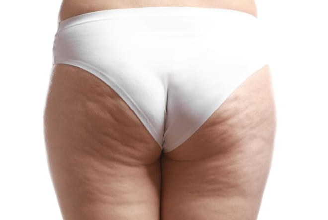 Stubborn cellulite At last A serious solution to improve those dimples