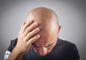 Why Men Go Bald - And Smart Solutions for Hair Loss