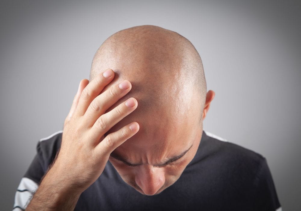 Why Men Go Bald - And Smart Solutions for Hair Loss