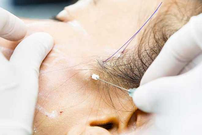Threads: The Anatomy of Lifting Sagging Skin