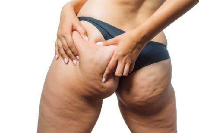 Good News About Cellulite Treatment: Stop Worrying and Take Action!