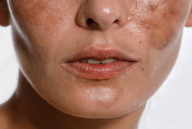 Fade to Flawless: The Latest in Pigmentation Peels