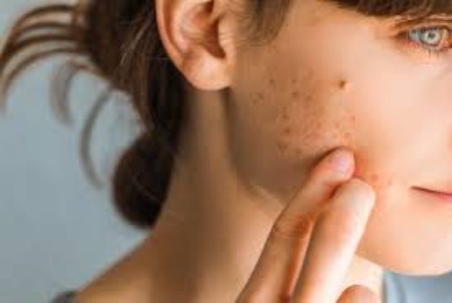 The Acne Breakouts Challenge: Treating Dark Marks Left Behind