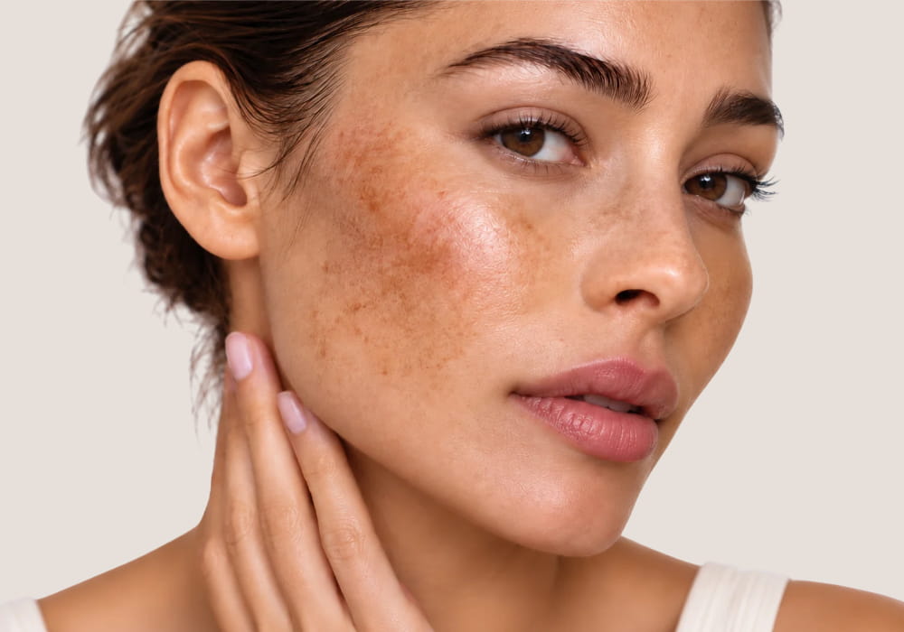 Melasma Isn't Just A Pigment Problem